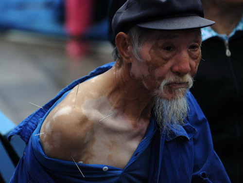 A man receives an acupuncture treatment on Wednesday at a relocation site in earthquake-hit Yiliang county, Yunnan province. Wei Xiaohao / China Daily