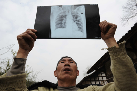 A black lung patient from Tongren, Guizhou province, looks at an X-ray of his lungs. Provided to China Daily