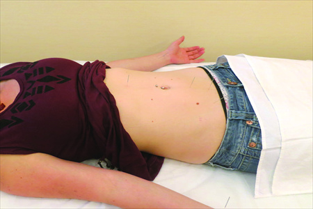 A foreigner receives acupuncture on her belly. Photo: Courtesy of Beijing Dongwen TCM Clinic