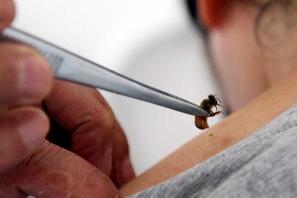 A bee sting is used to treat a patient at a traditional Chinese medicine clinic in Beijing. ZOU HONG / CHINA DAILY