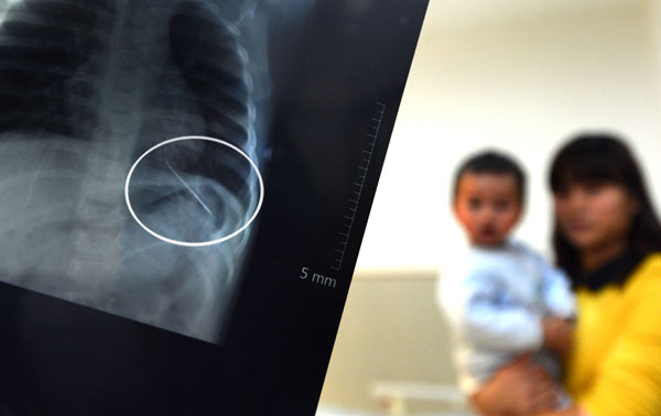 An X-ray shows a needle that was found inserted into the left lung of a 14-month-old boy in Nanjing, Jiangsu province, on Monday. Shi Xianghui / For China Daily