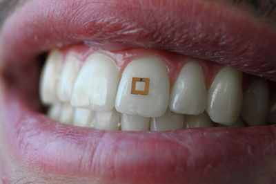 A miniaturized sensor mounted on a tooth. (Photo/SilkLab, Tufts University)