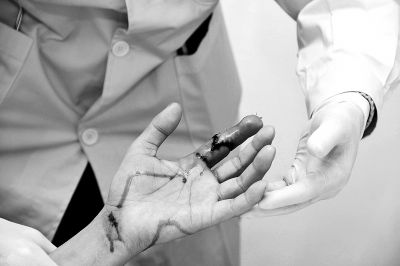 A man has a finger back lost 13 years ago following successful surgery that transplanted one of his toes onto his damaged hand. (Photo/dahe.cn) 