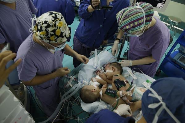 Conjoined twins separated in Shanghai