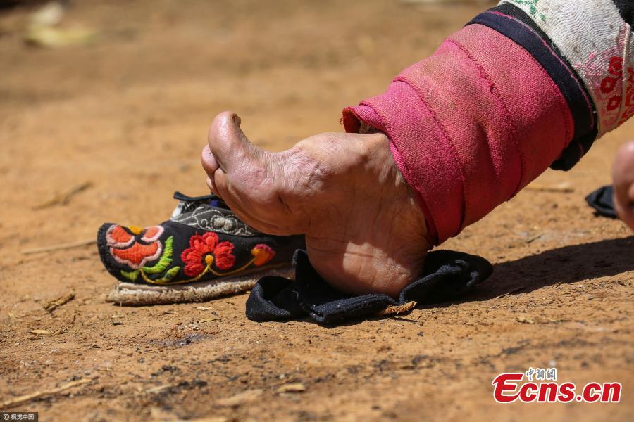 Women with bound feet still remain in rural China(2/3) - Headlines