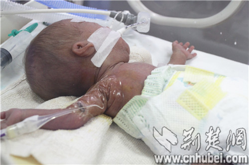 Photo taken on May 29, 2014 shows a premature baby boy in a hospital of Wuhan who was delivered nine weeks early and weighed only 500g at birth. Thanks to the efforts of medical staff, the baby survives. He is over four months old, weighs about 2400 grams and is getting ready to go home. [Photo: cnhubei.com]